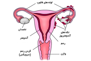  بیماری آندومتریوز