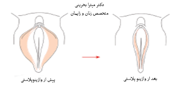 جراحی واژینوپلاستی