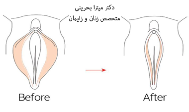 قبل و بعد لابیاپلاستی