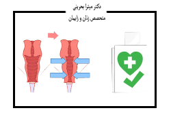 جراحی واژینو پلاستی