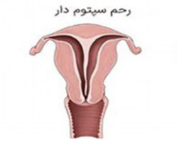 رحم سپتوم دار یکی از انواع اختلالات مادرزادی رحم